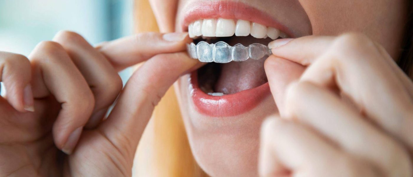 Achieving a Perfect Smile with Invisible Aligners in Balwyn