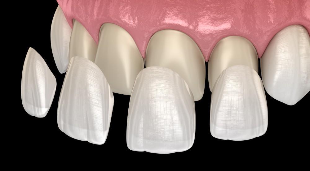 The Art of Smile Enhancement with Veneers in Liverpool